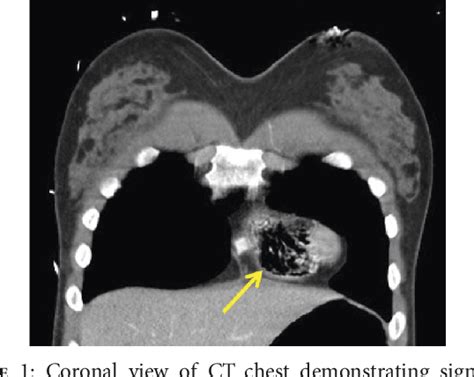 Intraoperative venous air embolism during neurosurgery.